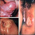 Kenapa Penis Sakit dan Bengkak thumbnail