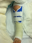 knee immobilizer and cast