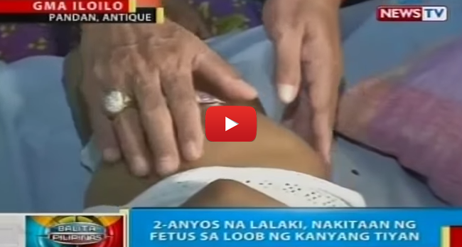 Watch Video of a 2-Year-Old Boy Have Fetus Inside His Stomach Know as ‘Fetus in Fetu’ Watch Video of a 2-Year-Old Boy Have Fetus Inside His Stomach Know as ‘Fetus in Fetu’