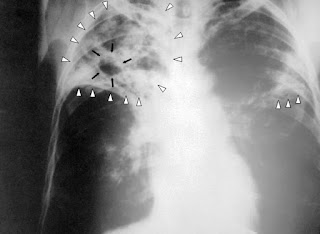 tuberculosis xray How Can You Know if You Have TB?