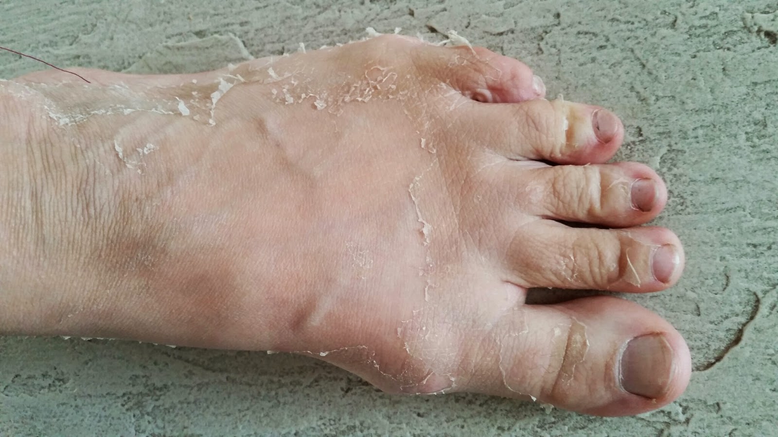 skin peeling on top of feet skin peeling on top of feet