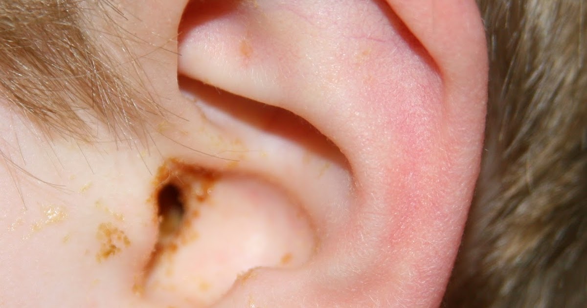 Say What? Rats (Another Ear Infection)