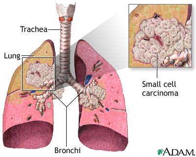 Lung cancer   non small cell   medlineplus