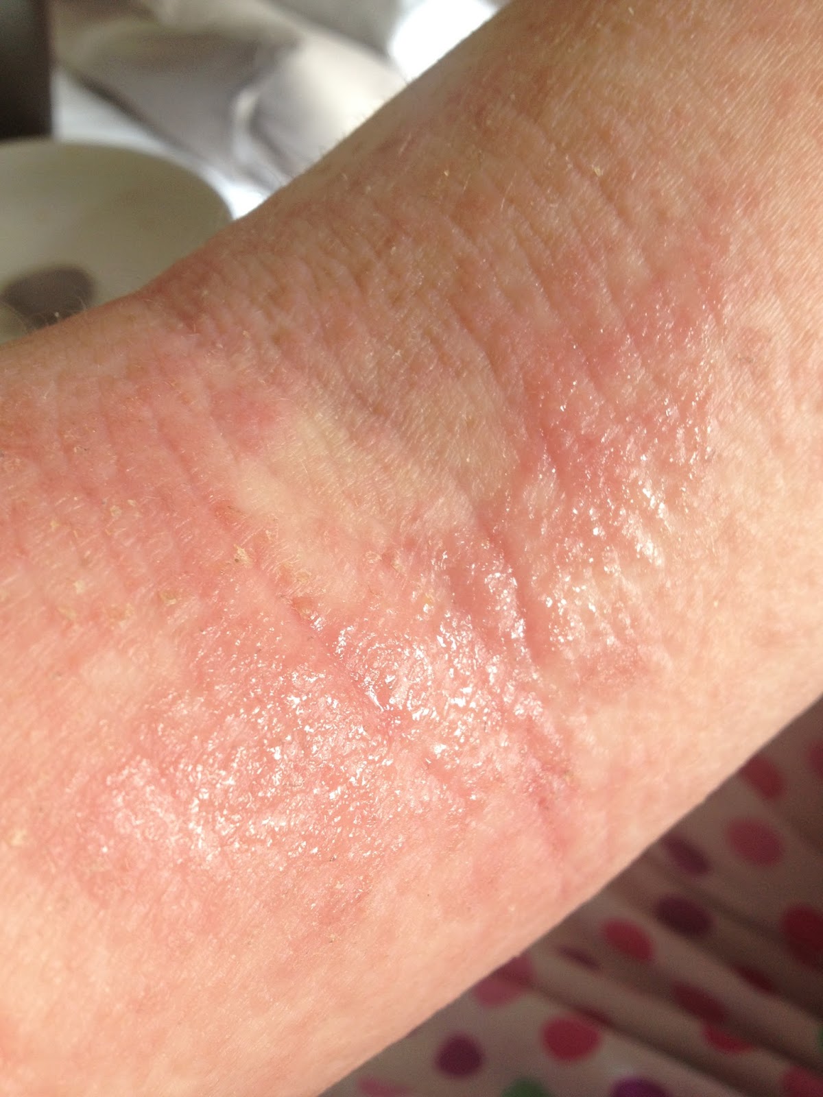 Weeping Wounds: What Causes Them And How To Treat Them Naturally - uc4xe7k