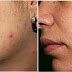 How To Get Rid Of Skin Acne With Neem