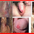 Obat Antibiotik Bentol dan Gatal Pada Alat Kelamin Wanita thumbnail