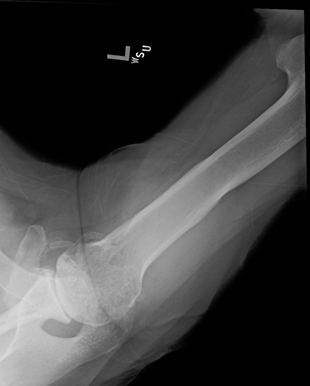 Shoulder Arthritis / Rotator Cuff Tears causes of shoulder pain Rotator cuff tear arthropathy