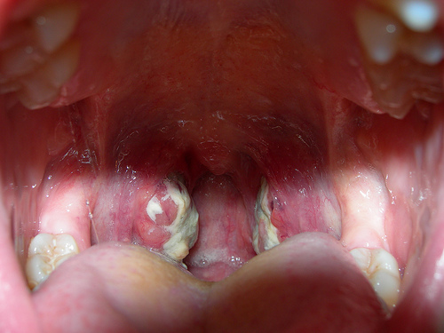 Tonsillitis Contagious With Antibiotics : Tonsil Stones Laser Removal