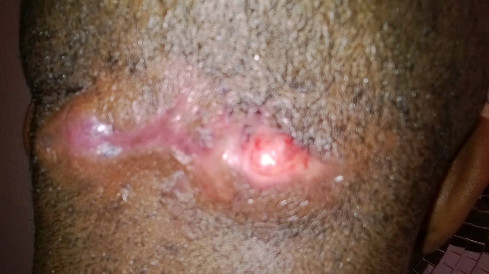 erythromycin 250mg qds erythromycin 250mg qds