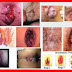 Salep Benjolan Ambeien Bengkak di Sekitar Anus thumbnail
