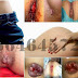 Wasir (Hemoroid) Banyak Diderita Wanita Karier thumbnail