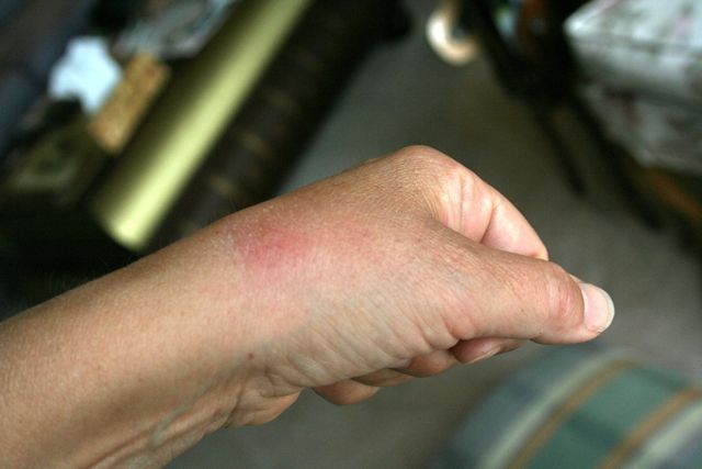 How To Relieve Bug Bites On Dogs How To Relieve Bug Bites On Dogs