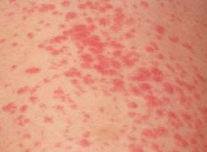Penyakit rubella atau campak jerman Penyakit rubella atau campak jerman