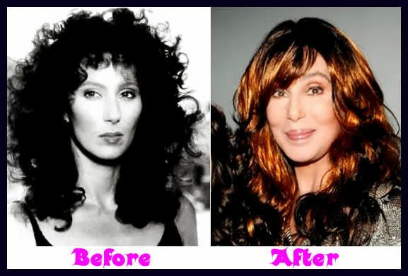 Cher Plastic Surgery Before and After Botox Injections Photos