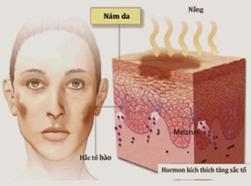 Nguyên nhân dẫn đến sạm da (nám da) và biện pháp phòng ngừa, khắc phục hiệu quả