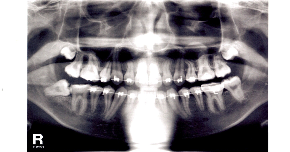 OrthoWorks Saving Impacted Molars