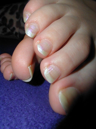 In some cases Toenail Fungus could be hereditary