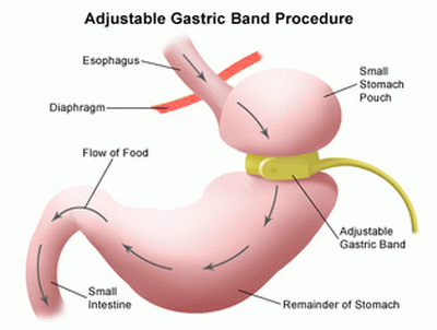 gastric bypass surgeons