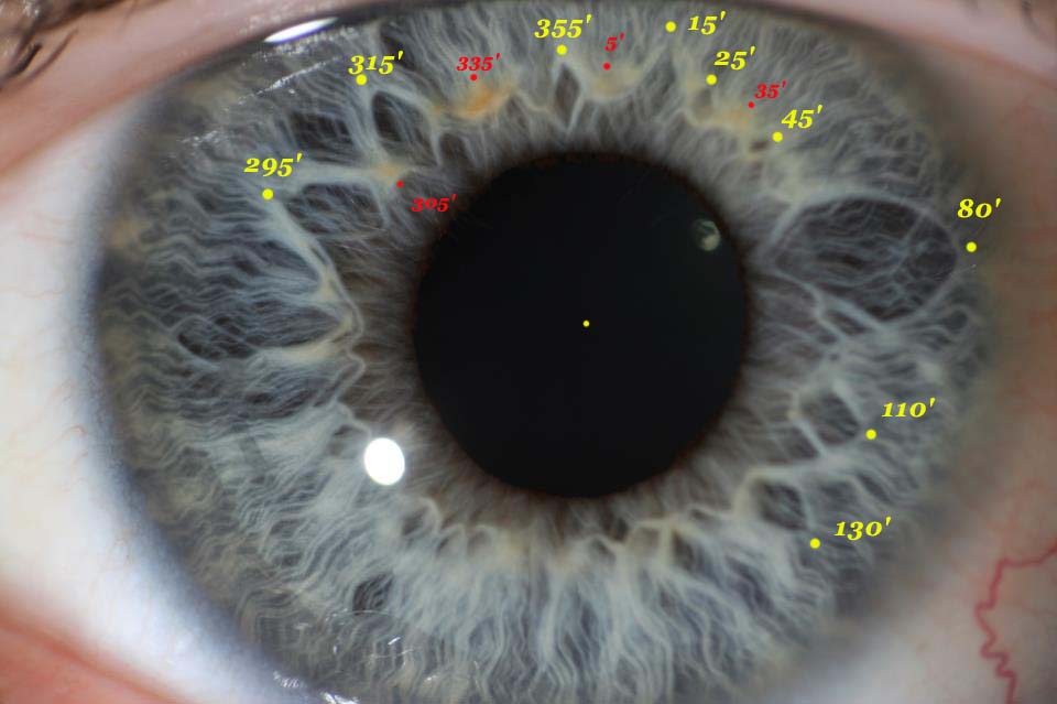 Modern & Multidimensional Iridology The Dynamics of the Collarette