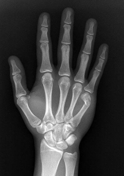 Young Athlete Center: Metacarpal Fracture