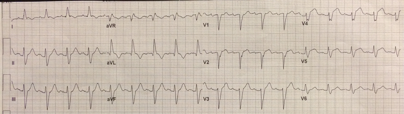 Nonspecific intraventricular conduction delay (defect) – ECG & ECHO