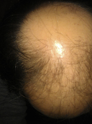 Regaine / Rogaine Foamwith Minoxidil - an attempt to regrow my hair