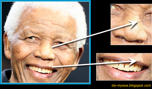 Blemishes In Mouth