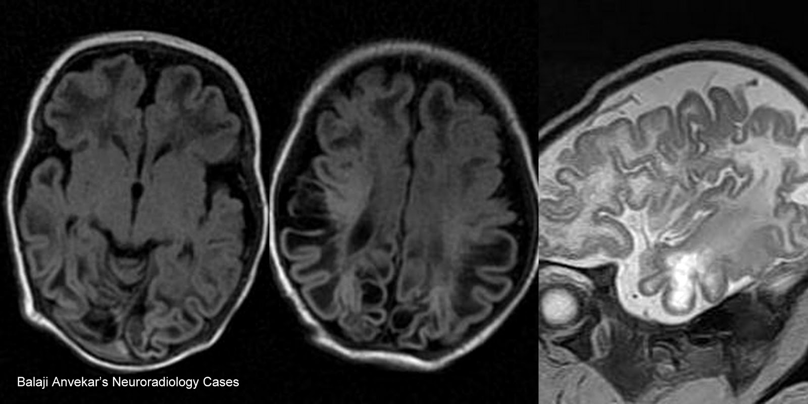 mri hersenen dementie