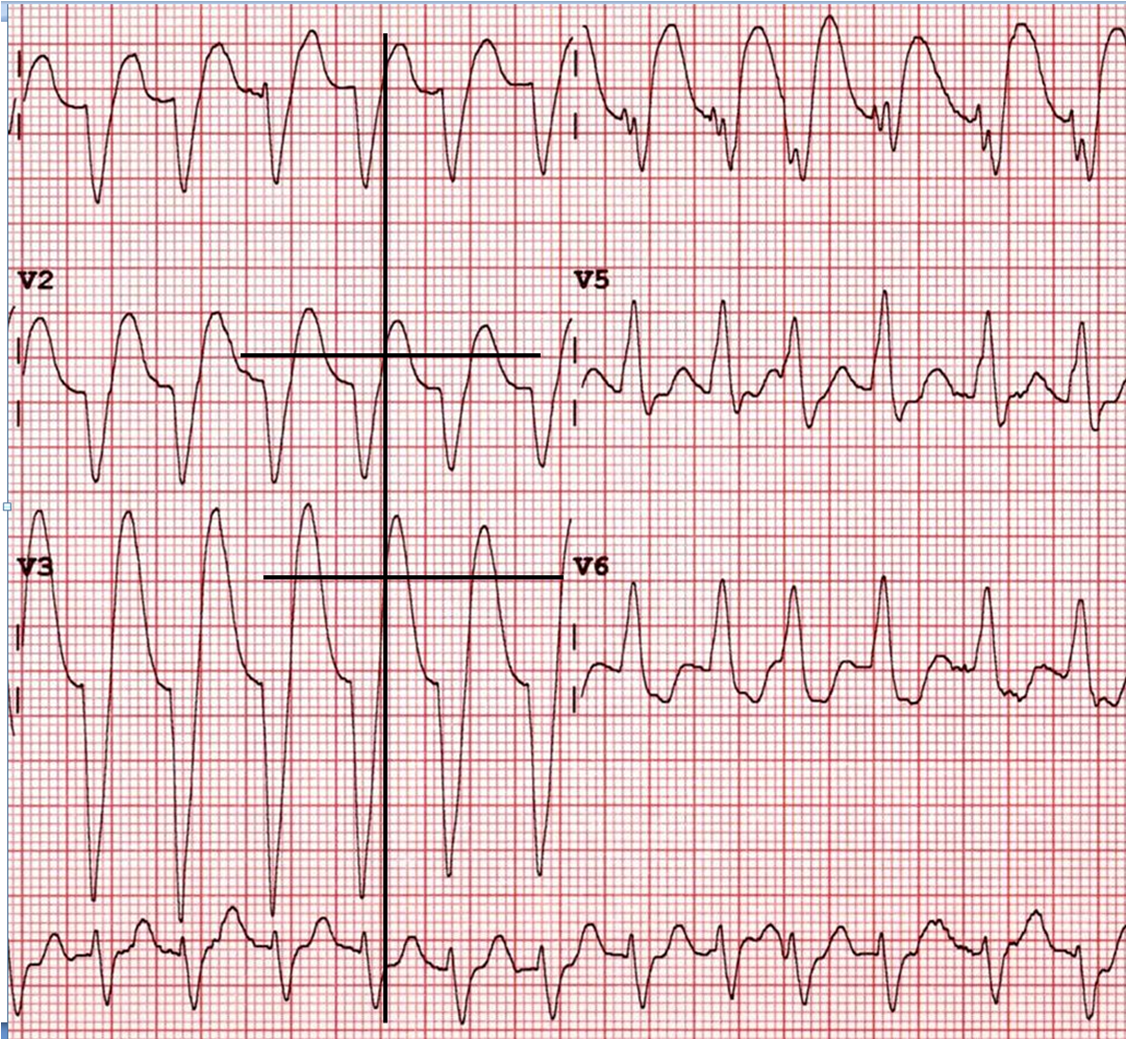 Dr. Smith's ECG Blog Left Bundle with Convex ST Segment Where is the