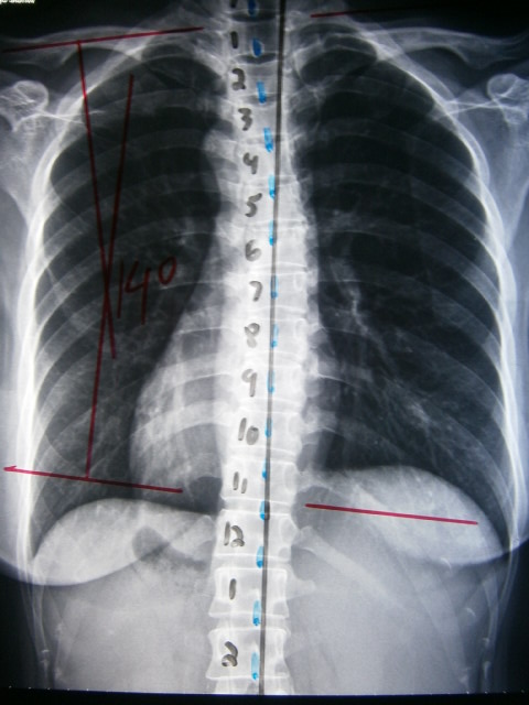 My twisted spine ~ We are the DinoFamily 我們是恐龍家族 | Singapore Parenting Blog