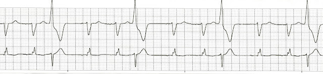 Trigeminy Ekg
