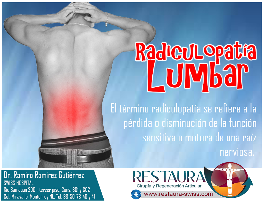 DrColumna: RADICULOPATÍA LUMBAR