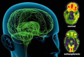 Brain imaging showing the effects of schizophrenia Brain imaging showing the effects of schizophrenia