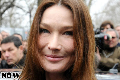 Carla Bruni Plastic Surgery on Carla Bruni Botox Plastic Surgery Before And After Nose Job