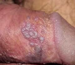 Herpes Di Batang Penis Herpes Di Batang Penis