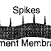 Membranous Glomerulonephritis causes, diagnosis, treatment, prognosis Membranous Glomerulonephritis causes, diagnosis, treatment, prognosis