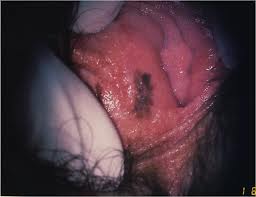vulva scura vulva scura