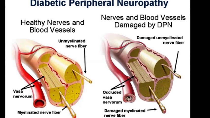 Home Remedies For Non Diabetic Neuropathy Home Remedies For Non Diabetic Neuropathy