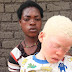 INTERNACIONAL / Por brujería aumentan asesinatos de albinos en Malaui, denuncia AI