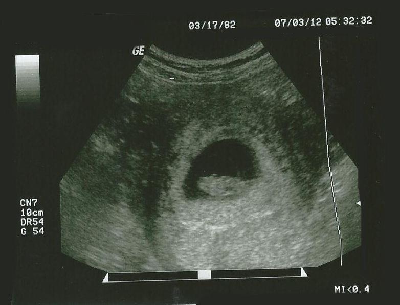 Pregnant and Diagnosed with Fifth Disease A Simply Enchanted Life