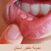 فطريات الفم وأهم العلاجات الطبيعية لها