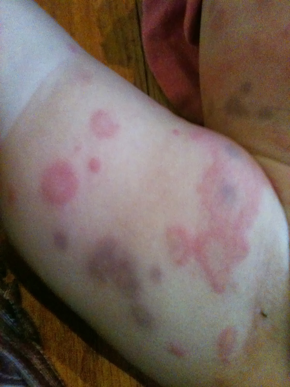 Four times More: The Worst Rash....Erythema Multiforme, An ...