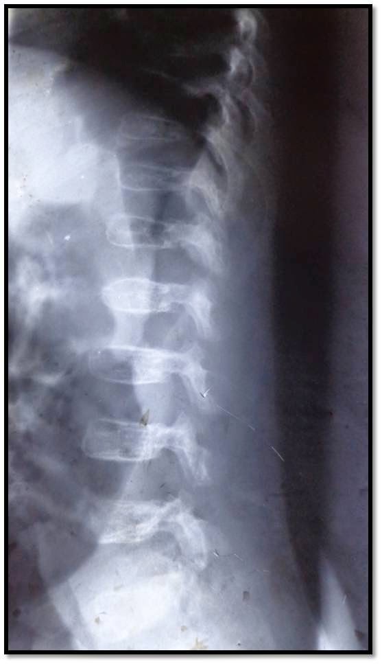RADIOLOGY IMAGE SPOTTERS Spondyloepiphyseal dysplasia