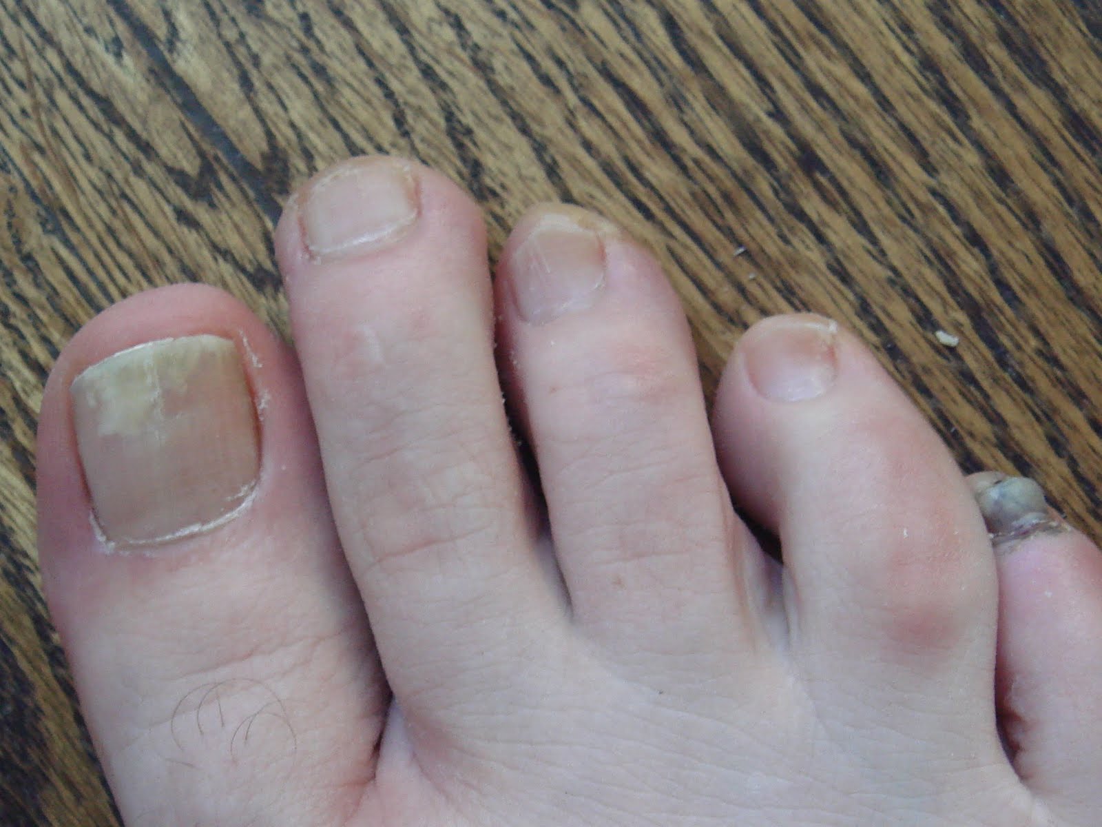 Tomypeck, en busca de nuevas metas. The Ugliest Runner's Feet Contest