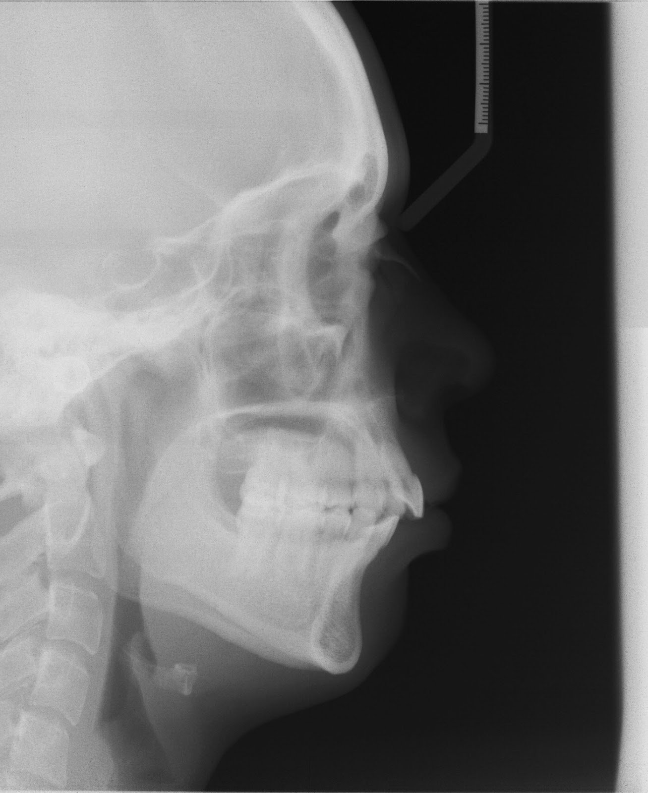 Truman Orthodontics Orthognathic Surgery