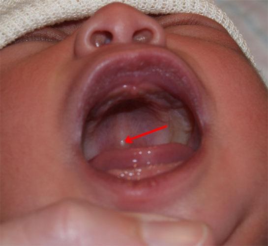 MEDICAL IMAGES Appearance of Epstein pearls in the mouth of newborn