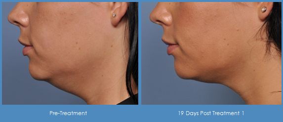 Ultherapy-Before-And-After-Chin-And-Neck