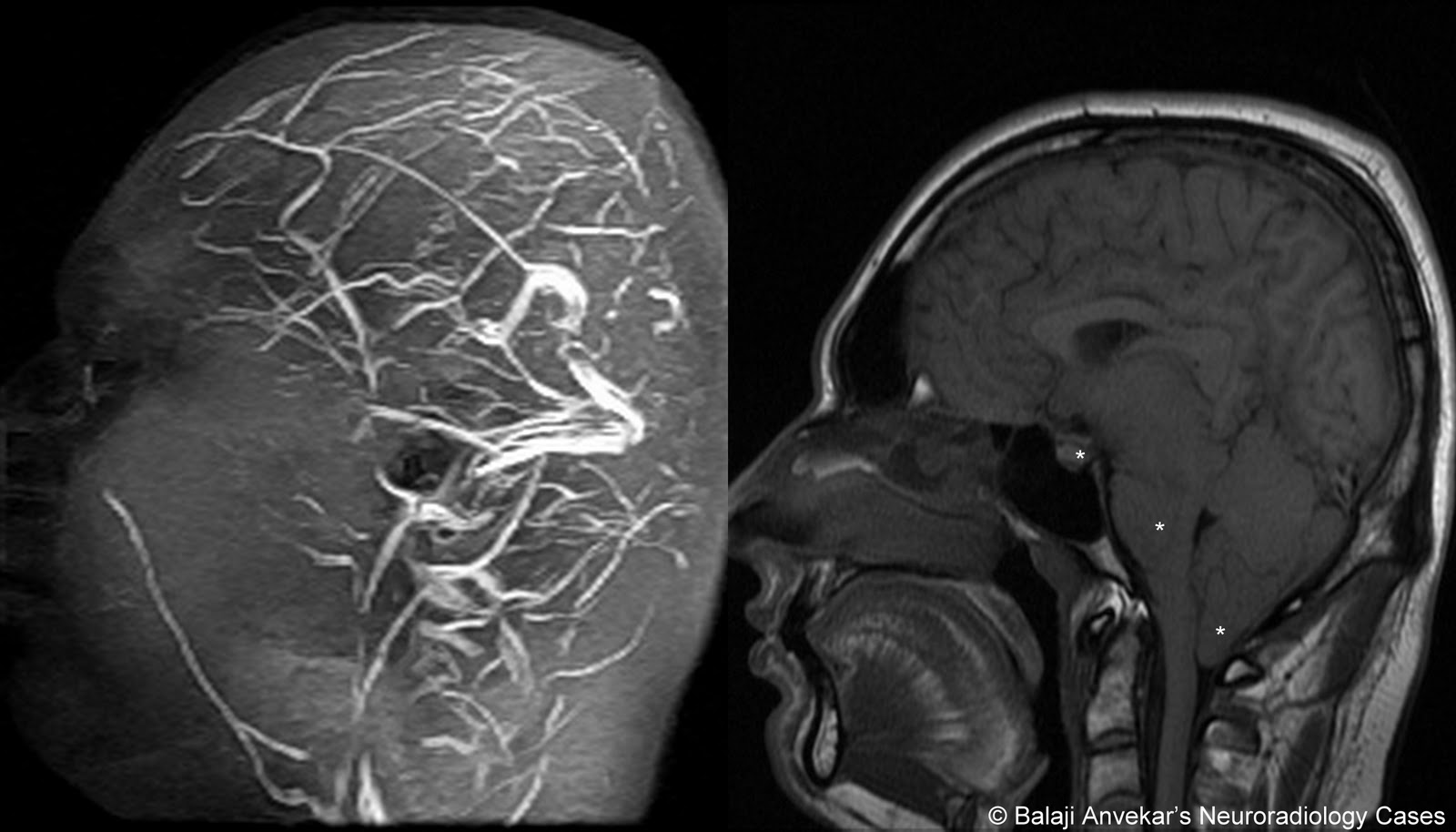 Cerebral Hypotension