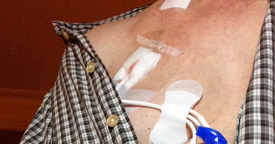 MDS in the family Hickman Line Day