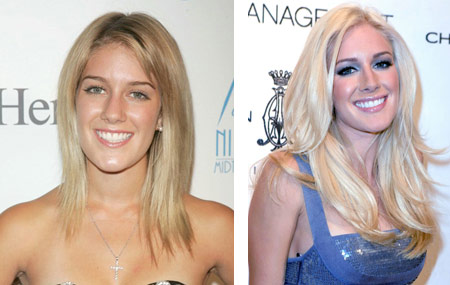 heidi montag before after. Heidi Montag Before And After